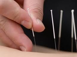 Akupunktura (Acupuncture)